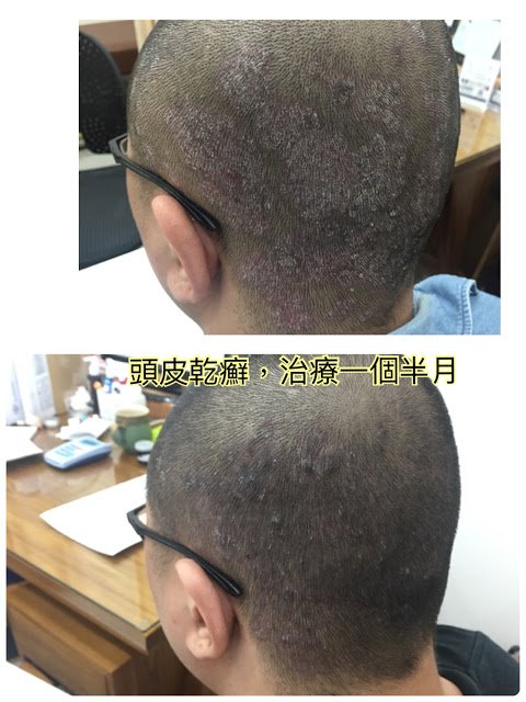 最困難的頭皮乾癬 也快速改善 中醫皮膚 Dr Syuan宣草集中醫診所 乾癬異位性皮膚炎專家