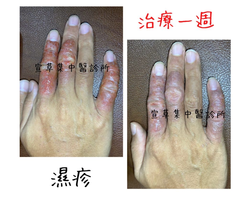 濕疹最好發這3類職人,中醫關鍵飲食和習慣擺脫汗皰疹富貴手! - Dr.Syuan宣草集中醫診所|乾癬脂漏性皮膚炎專家